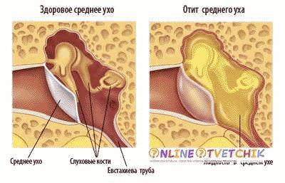 ухо при отите