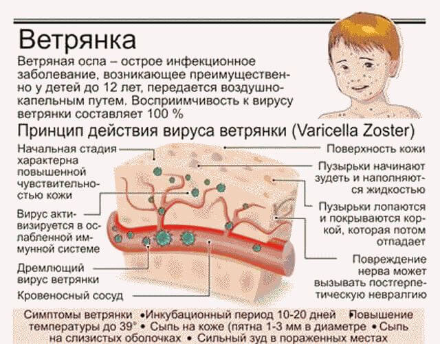 Симптомы ветрянки у взрослого человека