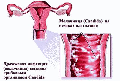 Язвы при молочнице фото