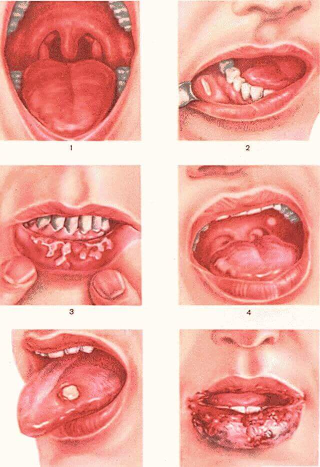 Как вылечить стоматит во рту быстро?