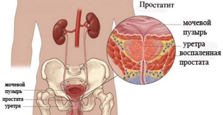 Простатит последствия